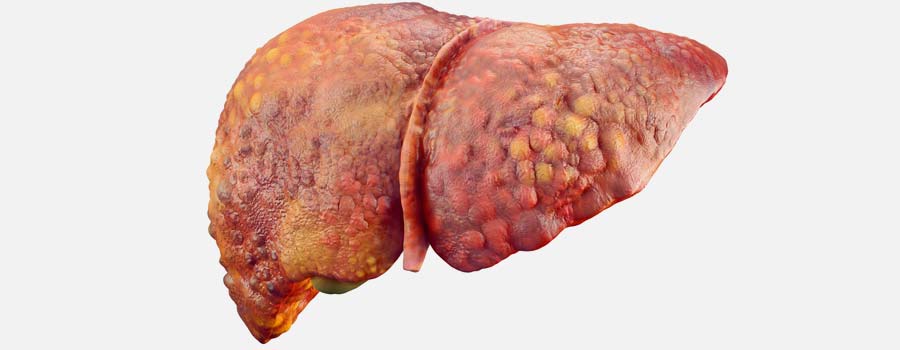 Signs of Liver Dysfunction
